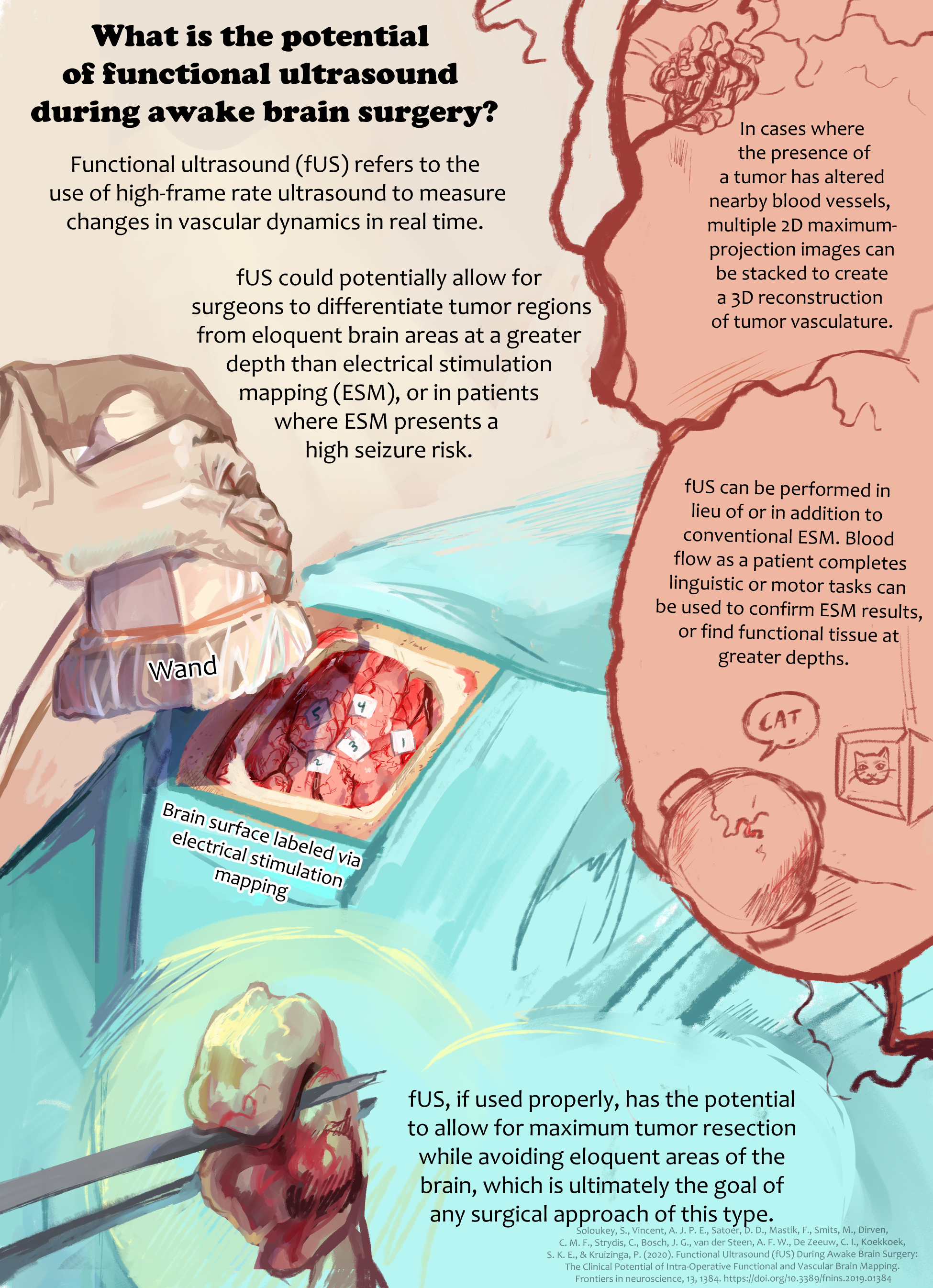 A poster on the use of functional ultrasound during brain surgery. Clip Studio Paint, 2022.